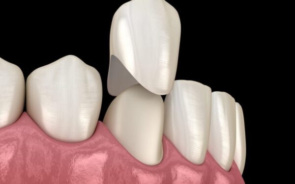 Chi phí cho từng loại vật liệu bọc 1 răng sứ?