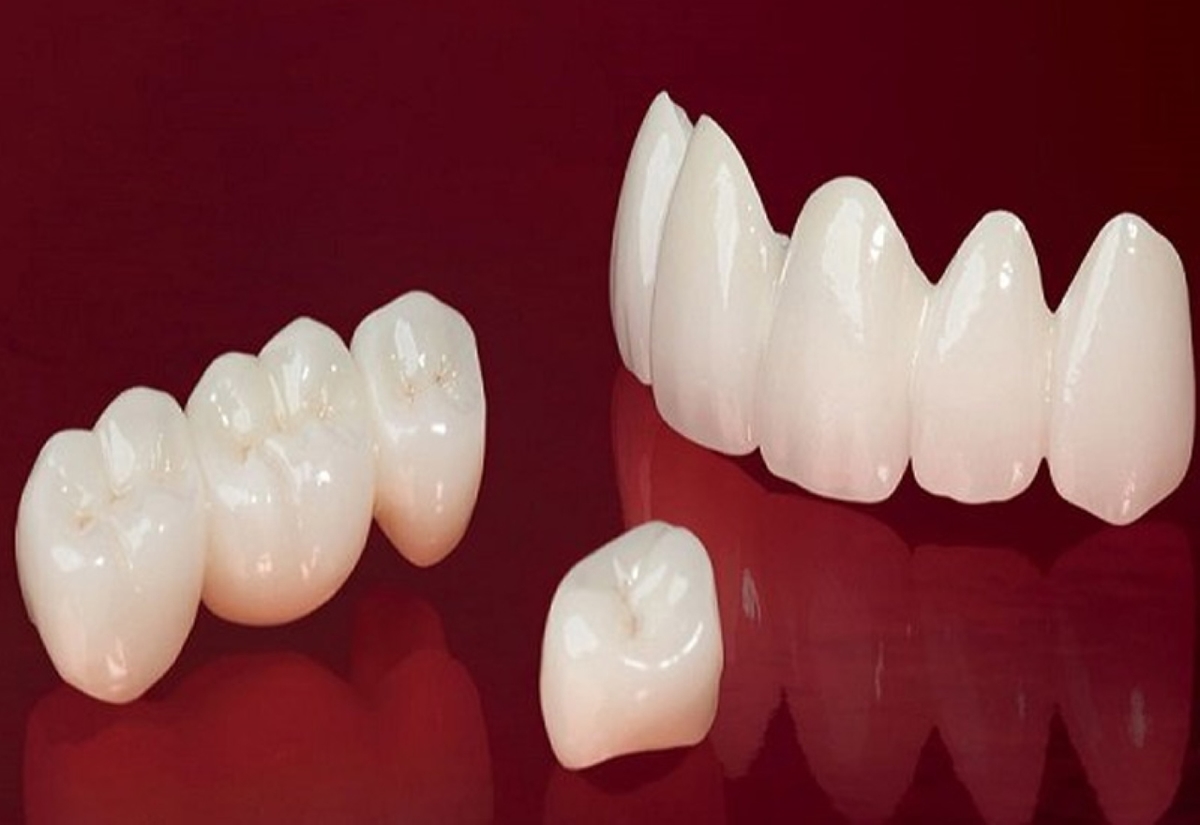 Những trường hợp nên bọc răng sứ hàm dưới