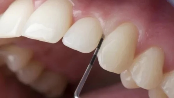 Bản chất của bọc răng sứ không cần mài thực chất là dán sứ Veneer