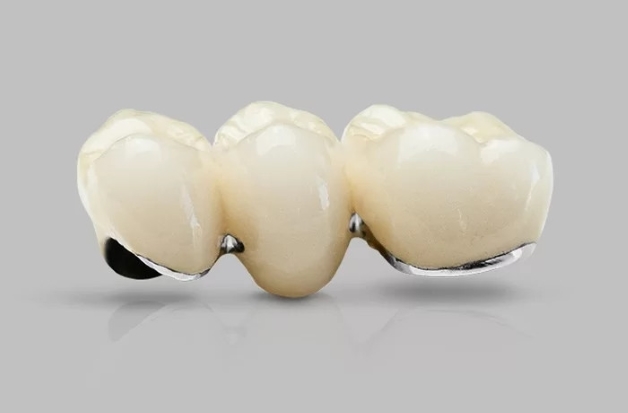 bọc răng sứ kim loại