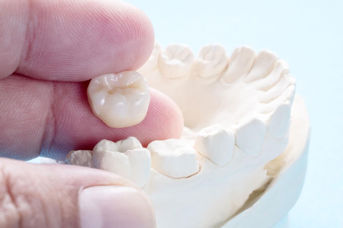 Giải đáp vấn đề bọc răng sứ uống bia được không