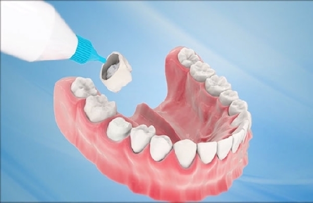 bọc răng sứ về bị đau