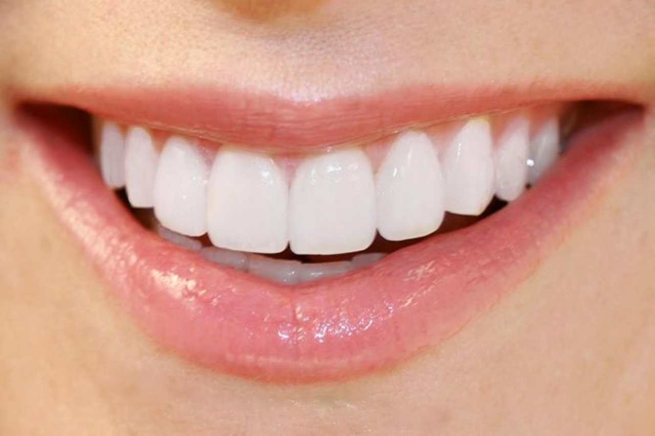 Hiệu quả bọc răng sứ cho 4 răng cửa bị hô