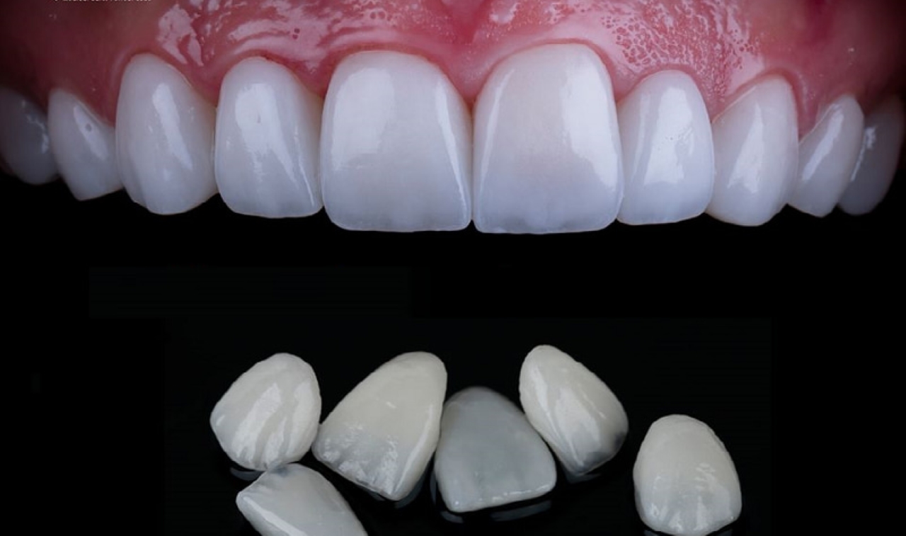 Điểm danh các loại răng sứ cao cấp