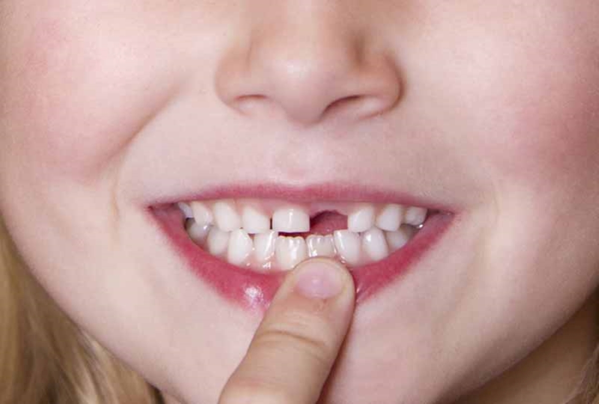 Mức độ an toàn của các cách làm răng sâu nhanh rụng tại nhà