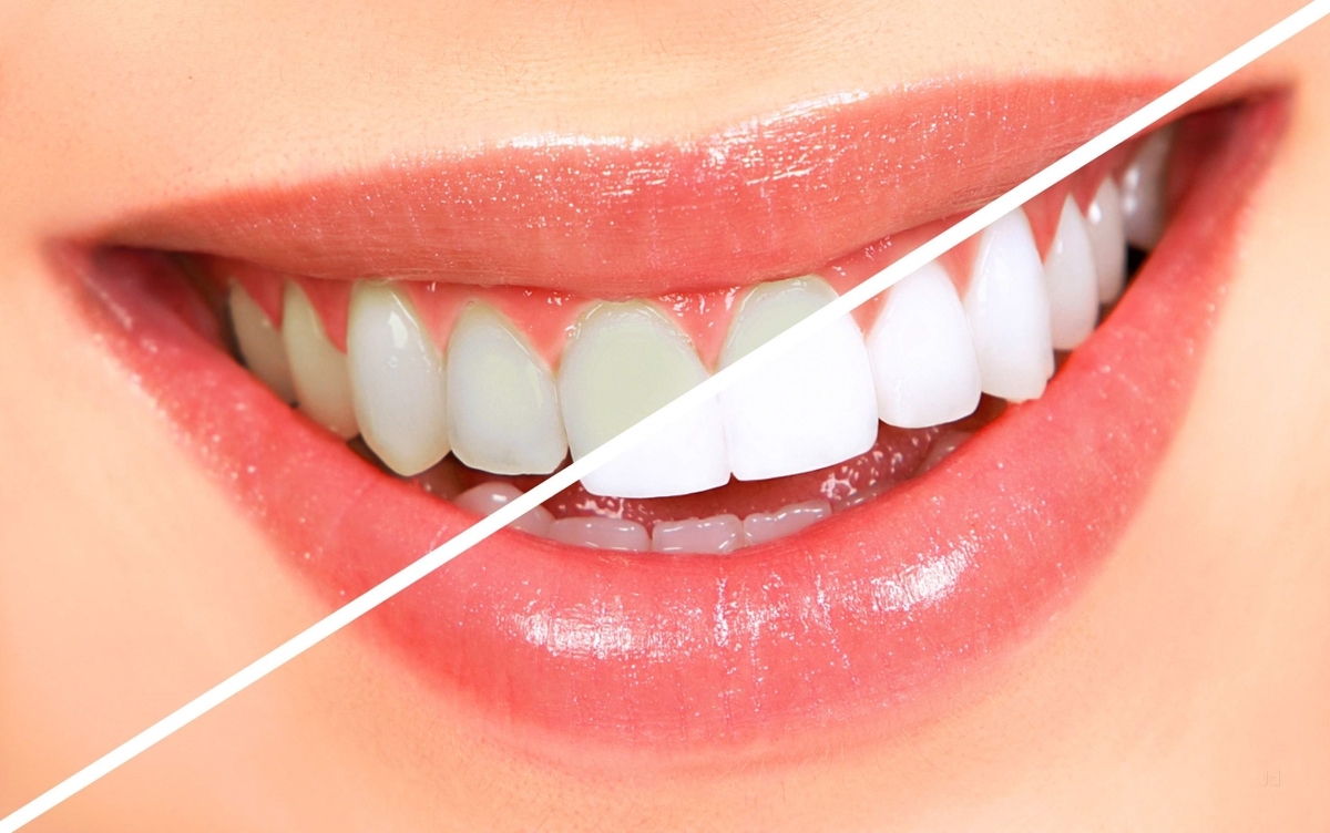Mách bạn những cách tẩy trắng răng cực tiết kiệm