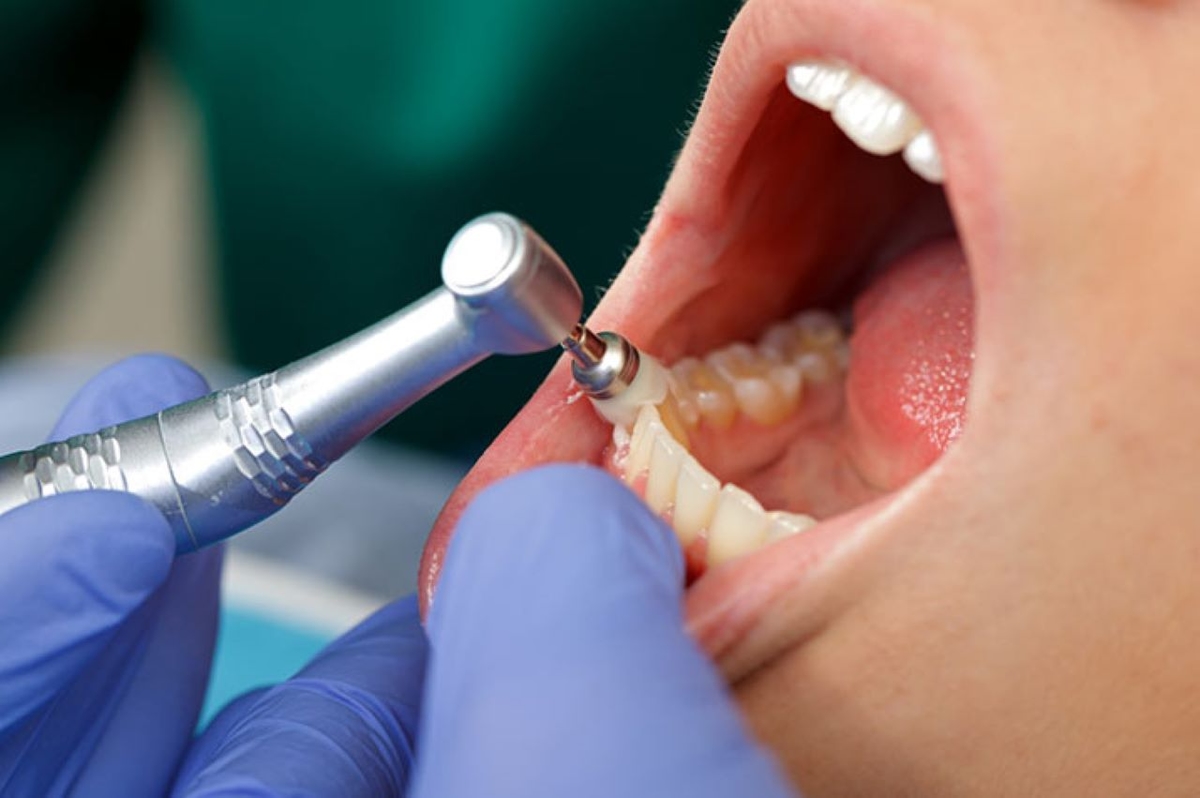 Cao răng có mấy loại và cách xử lý chúng hoàn toàn