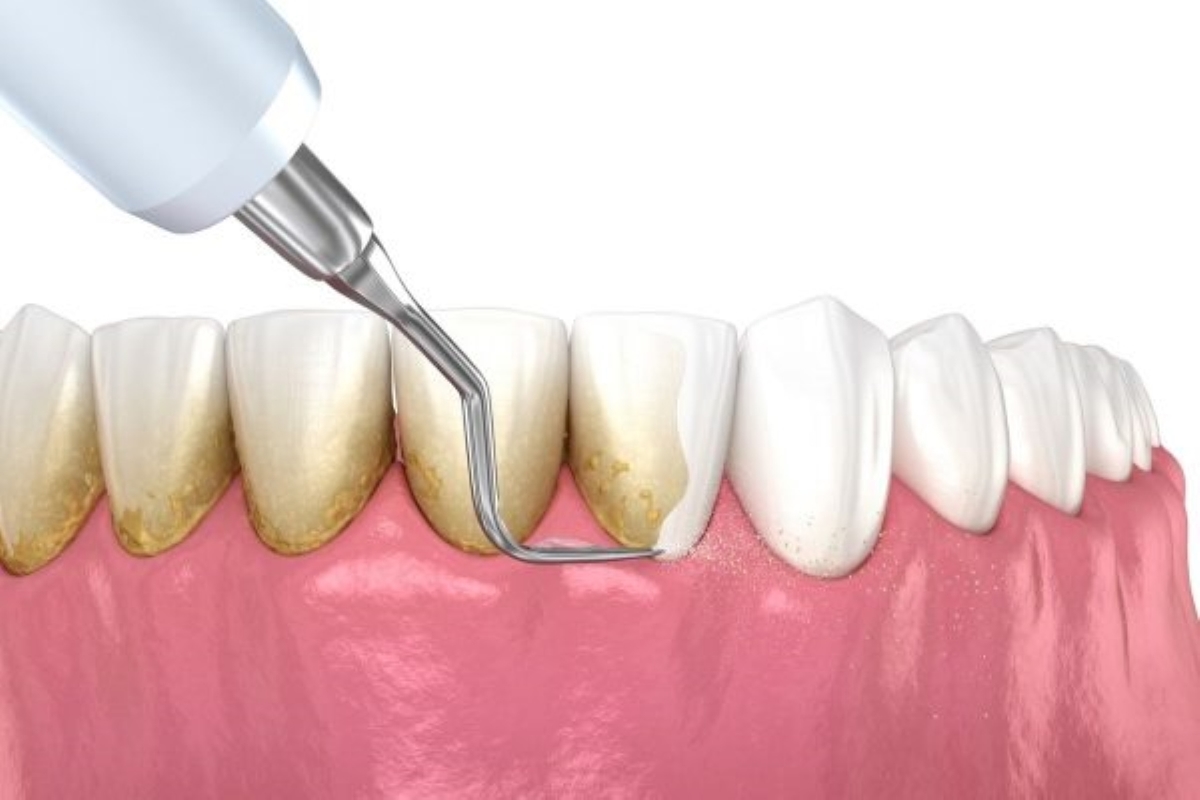 Cao răng tự vỡ và nguyên nhân