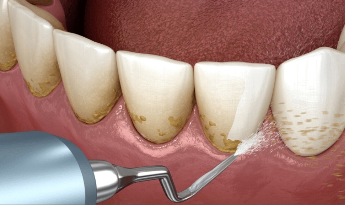 Sự thật về cạo vôi răng tẩy trắng răng