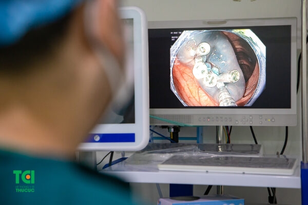 Cắt polyp đại tràng qua nội soi