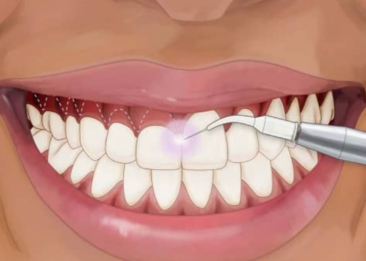 Dành cho những ai đang tìm thông tin chi phí điều trị cười hở lợi