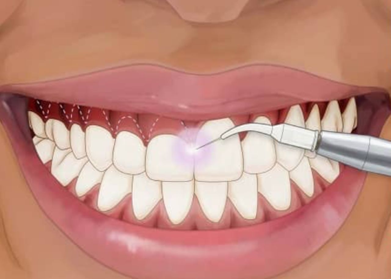 Dành cho những ai đang tìm thông tin chi phí điều trị cười hở lợi