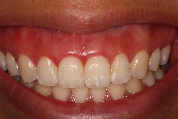 Chi phí điều trị cười hở lợi: Tất cả những gì bạn cần biết