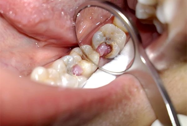 chi phí điều trị răng sâu lồi thịt