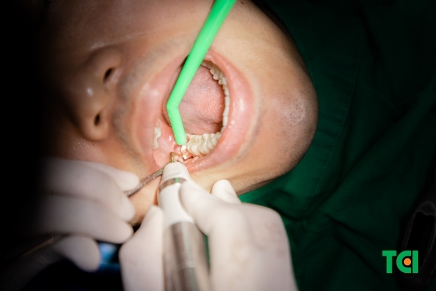 trị răng sâu lồi thịt