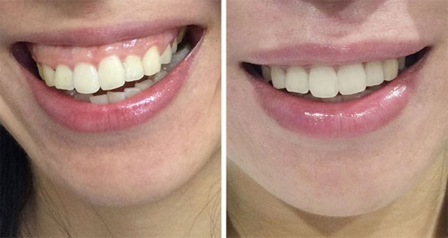 Thông tin cần biết về chi phí phẫu thuật cắt lợi