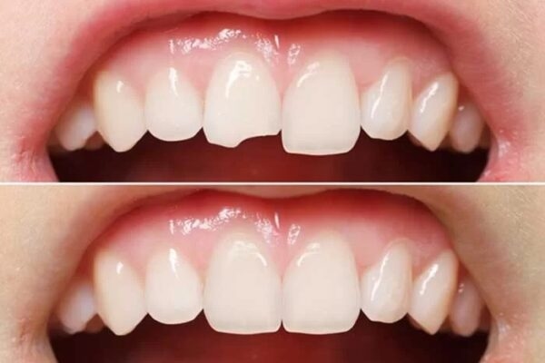 chi phí trám răng bị mẻ