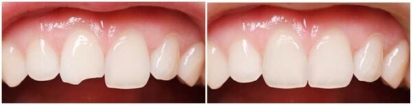 Khi nào thì phải trám răng mẻ?