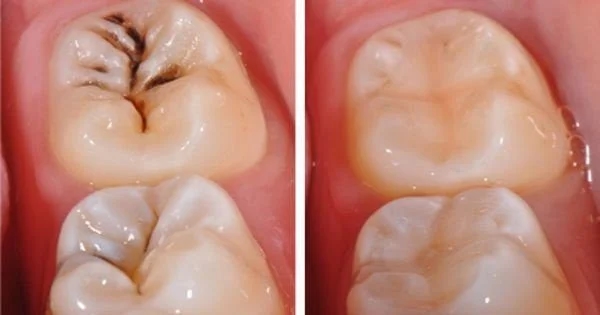 Chọn lựa phương pháp xử trí răng sâu như thế nào phụ thuộc vào thăm khám của bác sĩ