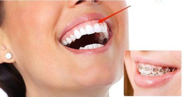 Trường hợp hở lợi nào niềng răng đạt hiệu quả cao?