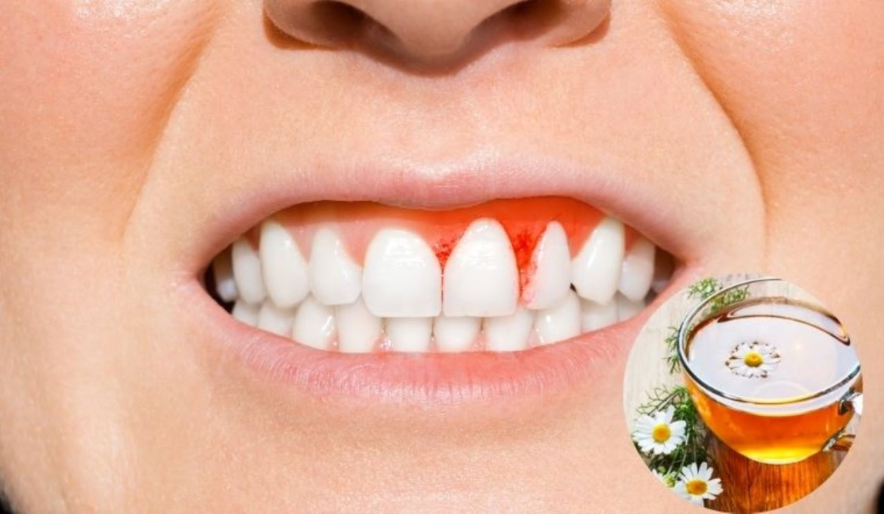 Xác thực cách chữa viêm chân răng bằng thuốc nam từ dân gian