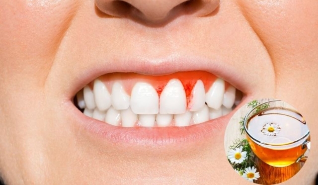 Xác thực cách chữa viêm chân răng bằng thuốc nam từ dân gian
