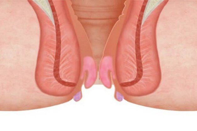 Chuyên trị bệnh trĩ 