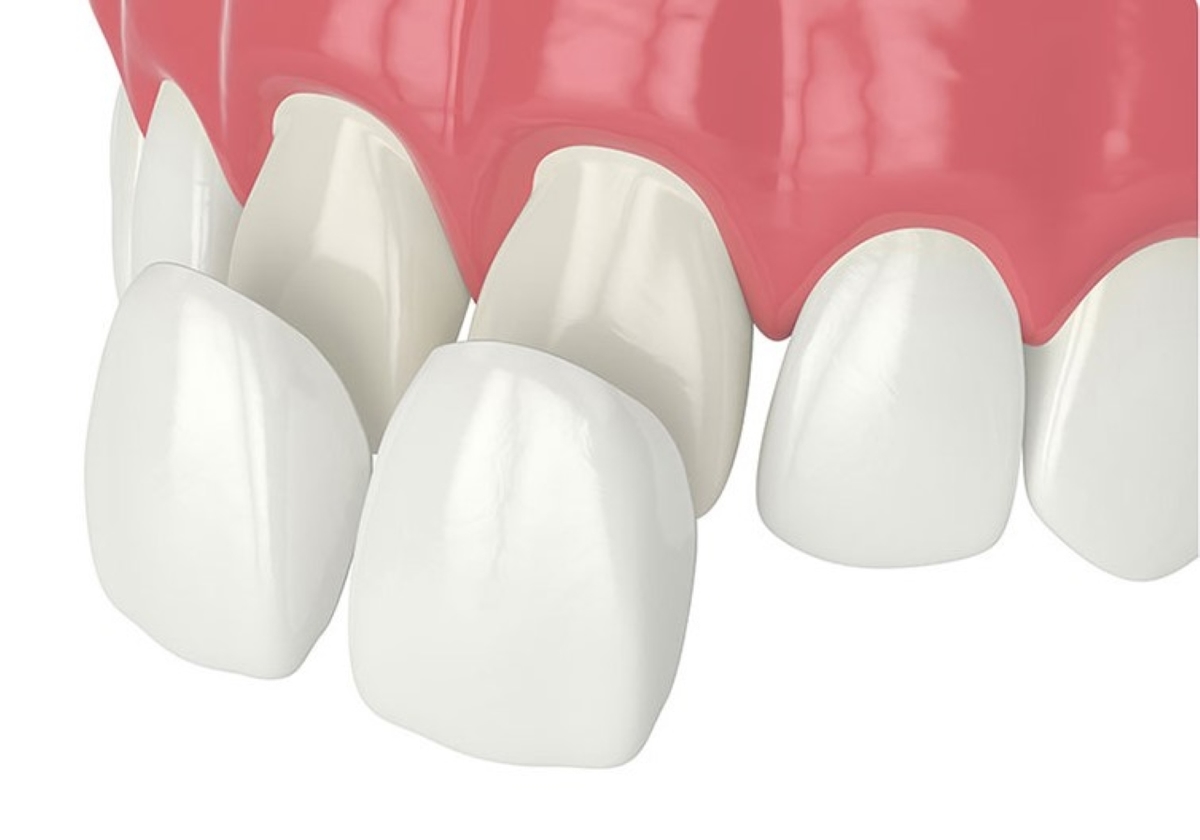 Giải đáp thắc mắc: Dán sứ Veneer có đắt không