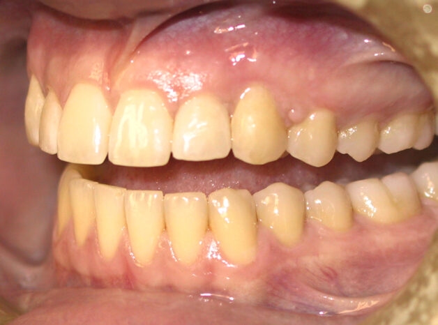 Tình trạng ố vàng, xỉn màu của răng có thể cải thiện hiệu quả bằng dán sứ veneer. 
