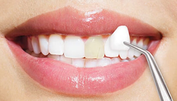 Có một số trường hợp nên áp dụng biện pháp dán sứ