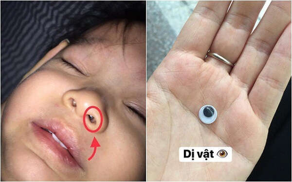 Xem ngay cách xử trí dị vật trong mũi bé