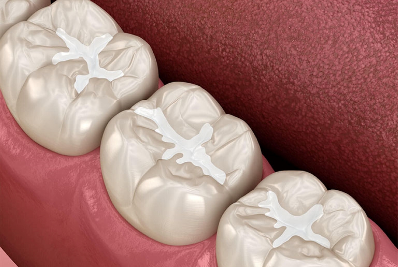 Những tiêu chí lựa chọn hàn răng ở đâu tốt