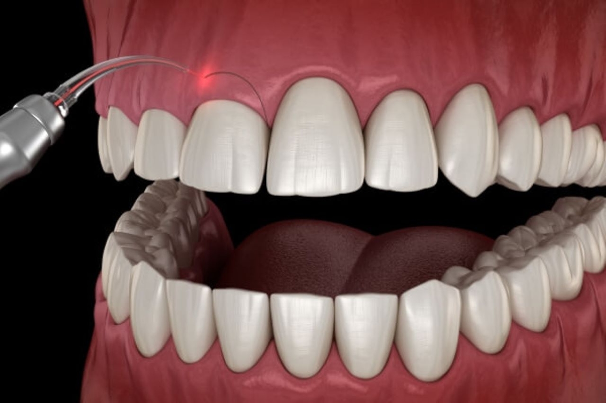 Dành cho những người muốn biết điều trị cười hở lợi ở đâu