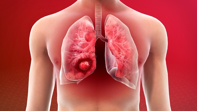Hiểu về phương pháp điều trị đích trong ung thư phổi