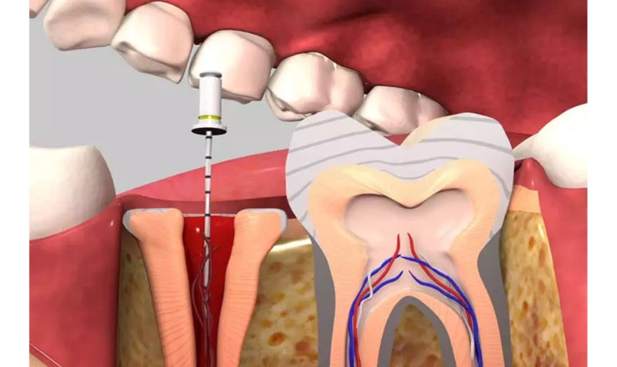 Điều trị tủy răng giá bao nhiêu tiền và quy trình thực hiện