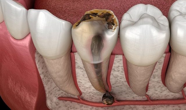 Phương pháp điều trị tủy răng khi mang thai