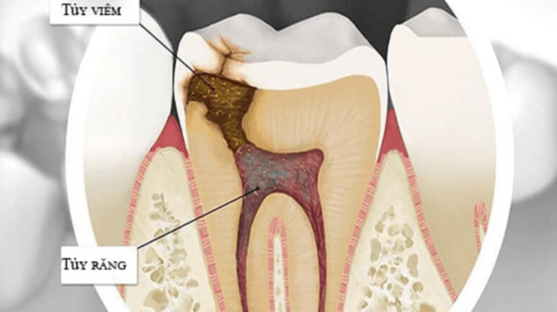 điều trị tủy răng khi mang thai