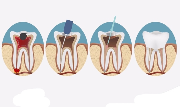 Tiêu chí điều trị tủy răng ở đâu tốt