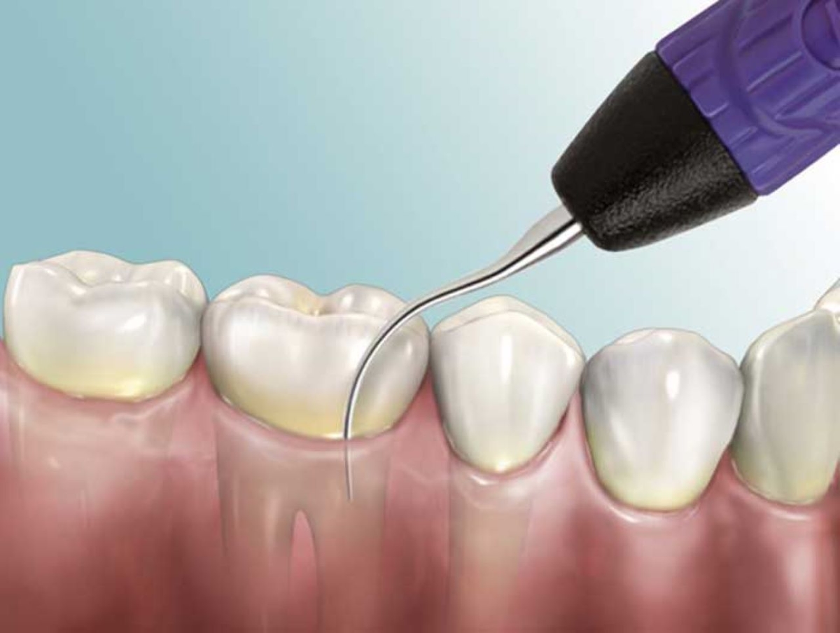 Thực hư việc dùng dụng cụ lấy vôi răng tại nhà
