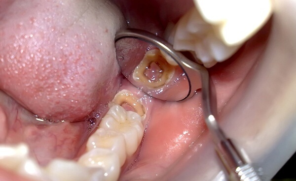 Thời gian điều trị tủy răng hàm