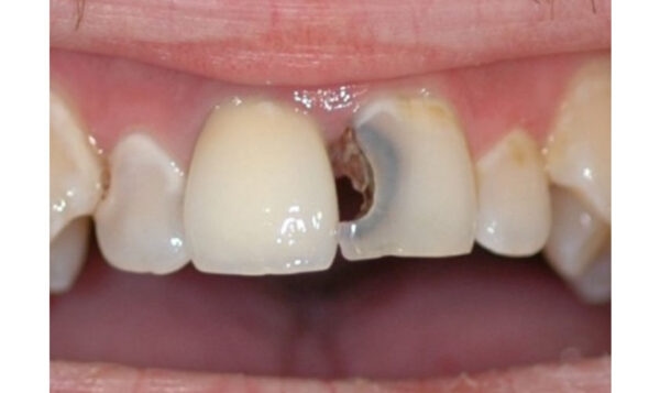 hàn răng cửa bị sâu