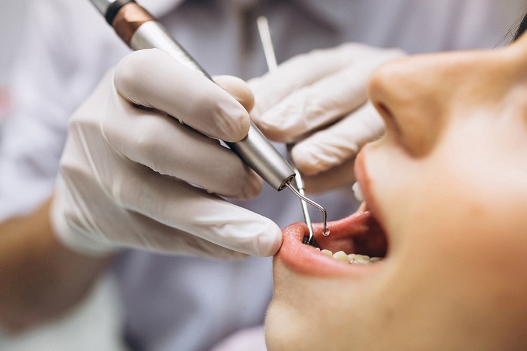 Có nên thực hiện hàn răng khôn khi bị sâu và những lưu ý