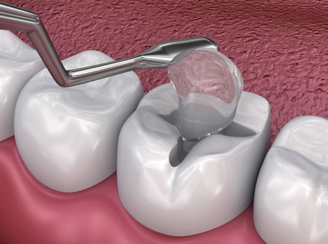 Hàn răng ở đâu an toàn, hiệu quả và những lưu ý