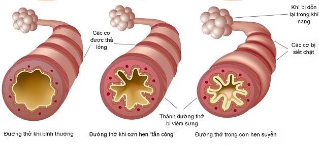 Hen phế quản là bệnh lý đường hô hấp 