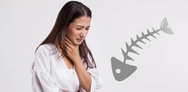 Hóc xương cá lâu ngày &#8211; Coi chừng biến chứng