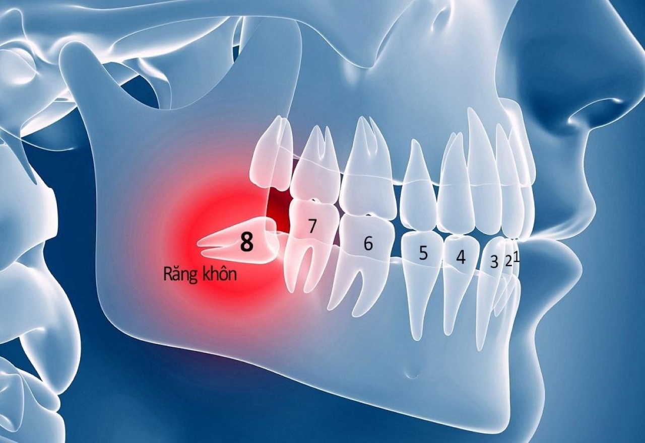 Dành cho những ai chưa biết khi nào cần nhổ răng khôn