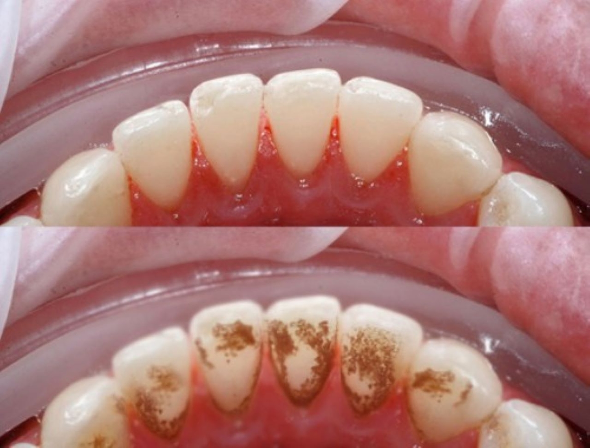 Mách bạn cách làm sạch vôi răng hiệu quả