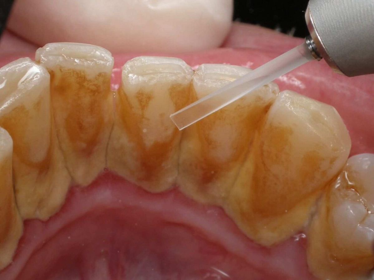 Thực hư tin đồn về hiệu quả lấy cao răng bằng muối