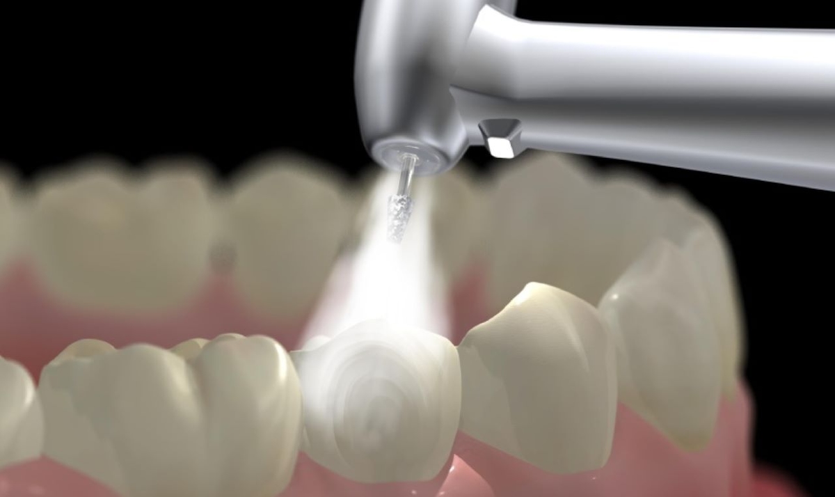 Lấy cao răng bằng sóng siêu âm, ưu điểm và quy trình