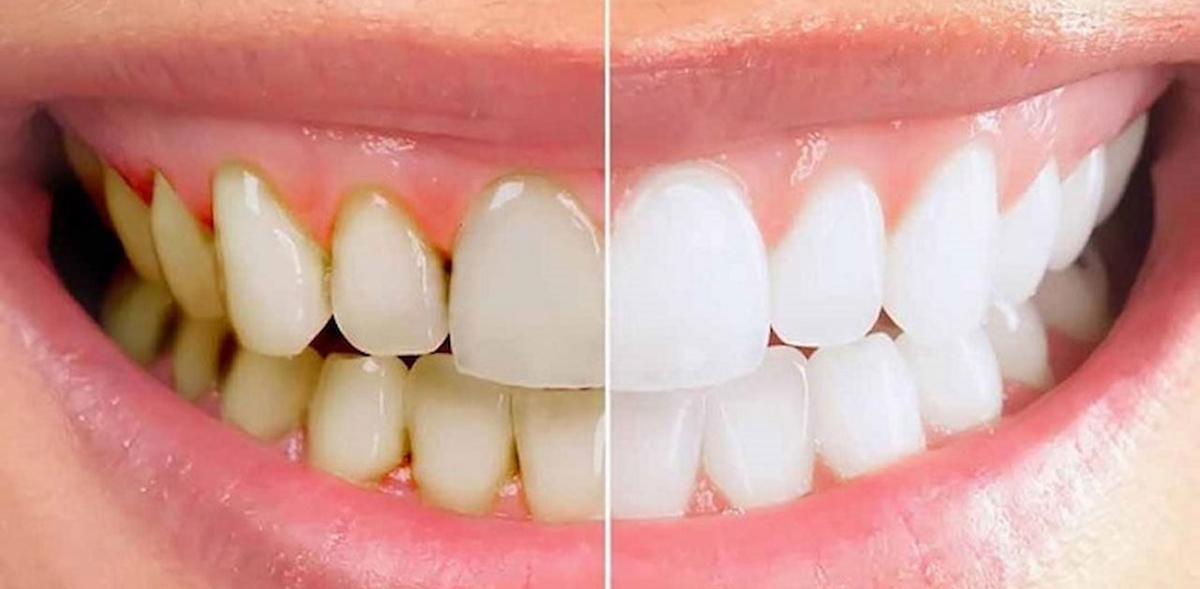 Lấy cao răng sóng siêu âm &#8211; Bước tiến hoàn hảo của nha khoa